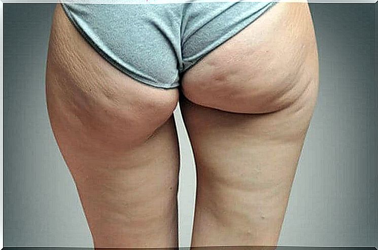 Woman with cellulite