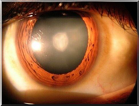 Nuclear cataract and cataract symptoms