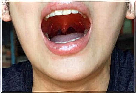 A woman with a swollen uvula