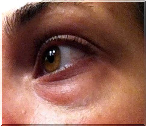 Natural remedies for bags under the eyes