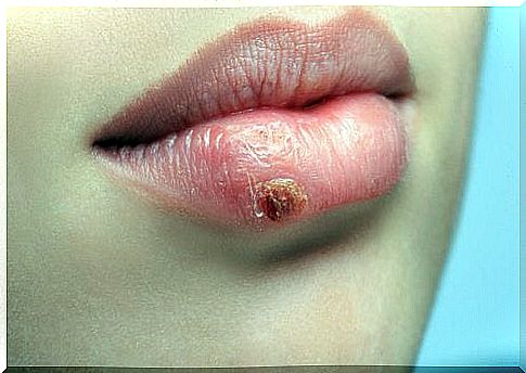 Prevent and treat cold sores naturally