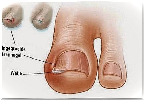 Six ancient remedies for ingrown toenails