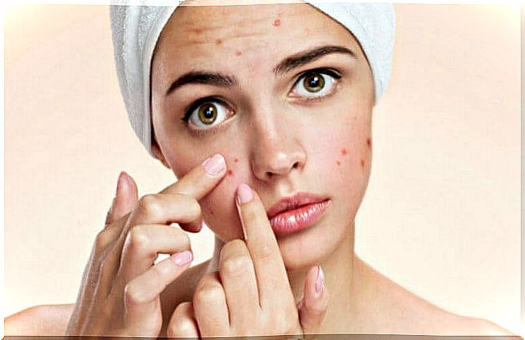 Woman feels acne
