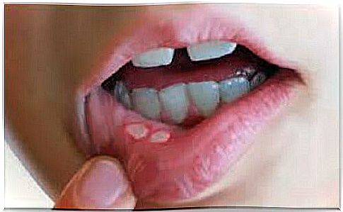 Treating and preventing canker sores